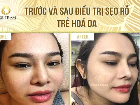 Lưu ý chăm sóc da đúng cách sau liệu trình laser