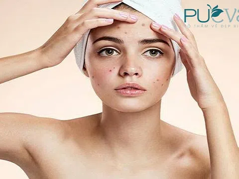 Biểu hiện bị rối loạn nội tiết tố nữ lên làn da như thế nào?