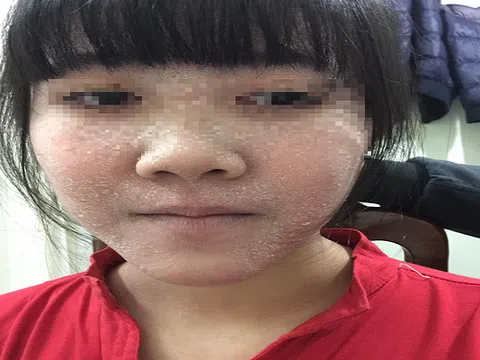 Tiết lộ bí quyết đánh bay viêm da cơ địa bằng Đông Y