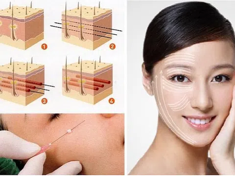 Nâng cơ mặt chảy xệ bằng chỉ Ultra V Lift không cần phẫu thuật tại TMV Bắc Mỹ Thanh Hoá