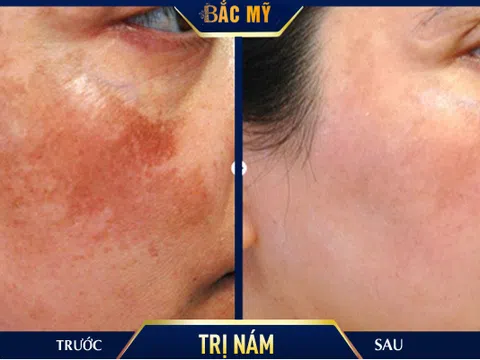 Điều trị nám bằng Laser picosure tại TMV Bắc Mỹ – Công nghệ trị nám tận gốc tiên tiến nhất năm 2020