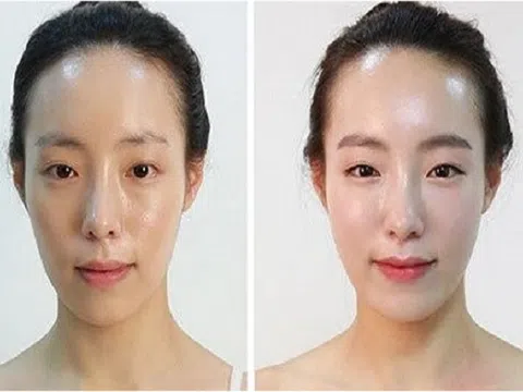 Thông cơ tạo má baby – Cải não hoàn đồng tại TMV Bắc Âu