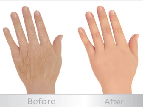 Có nên tiêm filler ngón tay hay không?