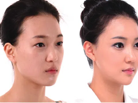 Đừng hiểu lầm bản chất của tiêm filler độn thái dương!