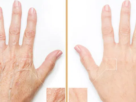 Tiêm filler bàn tay - lựa chọn vàng níu kéo tuổi xuân