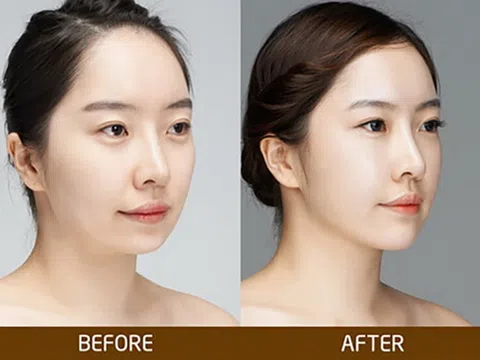 Tiêm filler đầu mũi – Khái niệm và ưu điểm