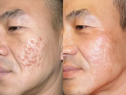 Làm đầy sẹo lõm bằng filler có an toàn không?