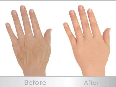 Tiêm filler làm đầy bàn tay và những ưu điểm không thể phủ nhận