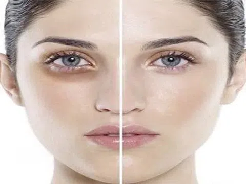 Tiêm filler thâm mắt và trũng mắt - bạn có tin không?