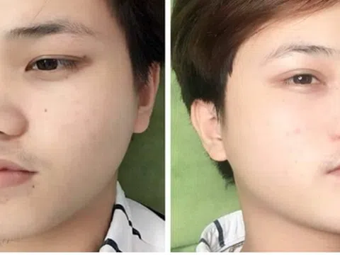 Tiêm filler thu gọn cánh mũi và những điều cần biết