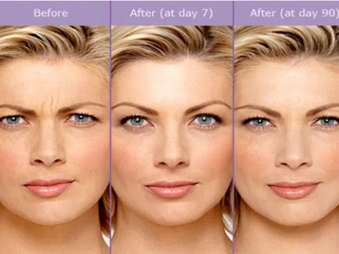 Tiêm filler trán có hại không?