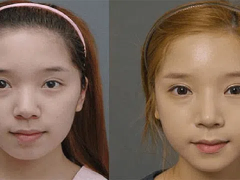 Làm đầy má hóp có đau không? Có nguy hiểm không?