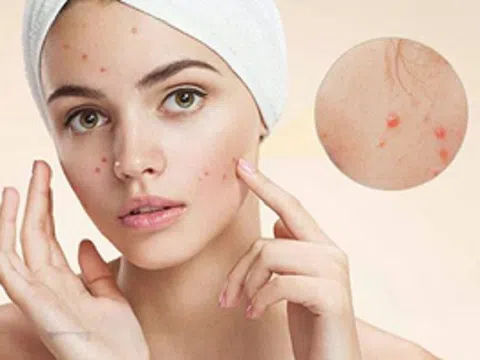 Mụn Trứng cá- Nỗi ám ảnh vì làn da xấu xí