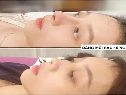 Nâng mũi bằng Filler không đáng sợ - Đáng sợ ở 'người tiêm' và Filler 'dỏm'