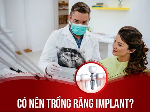 Giải đáp từ bác sĩ: Có nên trồng răng Implant?