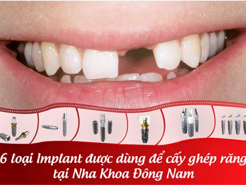 6 loại Implant được dùng để cấy ghép răng hiện nay