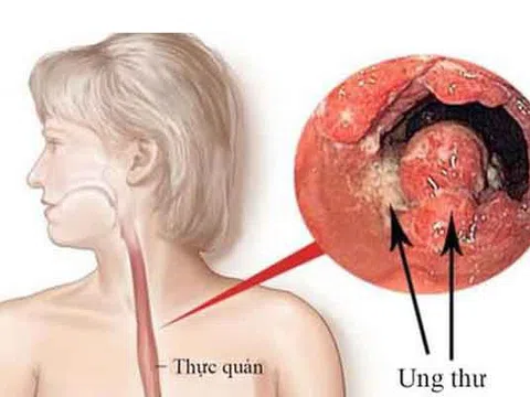 Chuyên gia chỉ cách cải thiện trào ngược dạ dày bằng nước uống tốt