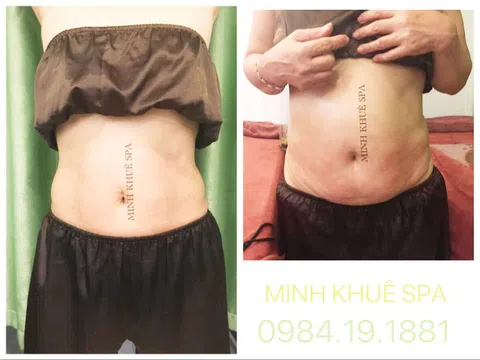 Phương pháp giảm mỡ bụng nhanh chóng, hiệu quả, đảm bảo mỡ thừa không quay lại
