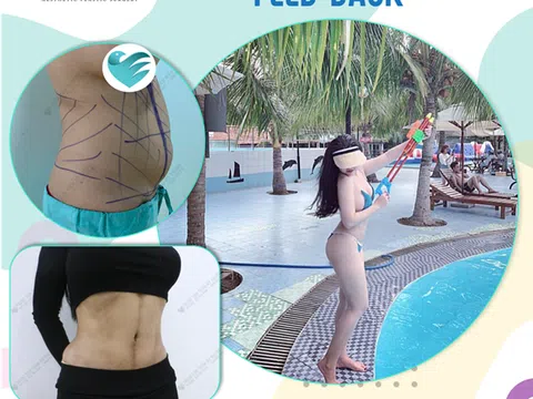 Hút mỡ bụng uy tín và những lưu ý cần biết
