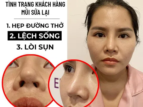 Không tìm hiểu kỹ địa điểm thẩm mỹ, nhiều chị em phải sửa mũi đến lần thứ 5