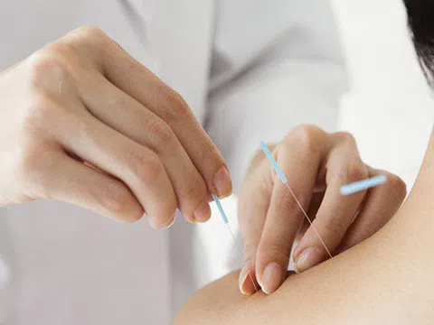 Châm cứu: Hiểu thế nào cho đúng?