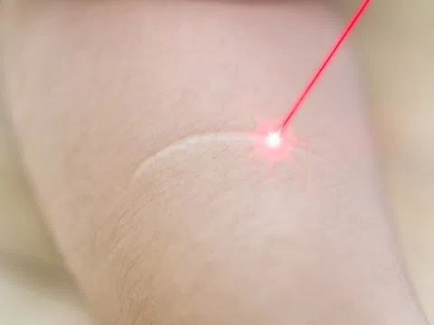 Biến chứng vì sử dụng kỹ thuật cắt đáy sẹo bừa bãi
