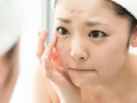 Cấp cứu da mặt đột nhiên bị ngứa và nổi mụn