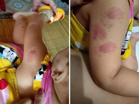 Trách nhiệm trong giáo dục trẻ mầm non nhìn từ vụ bé gái 21 tháng tuổi đi học bị cắn tím người