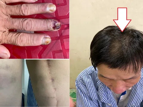 Vĩnh Tuy (Bắc Quang – Hà Giang): Cần làm rõ hành vi đánh đập dã man công dân với lý do sai sót nghiệp vụ?