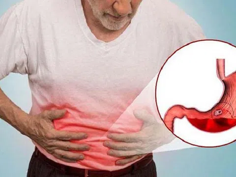 Dấu hiệu cảnh báo dạ dày đang gặp vấn đề nghiêm trọng
