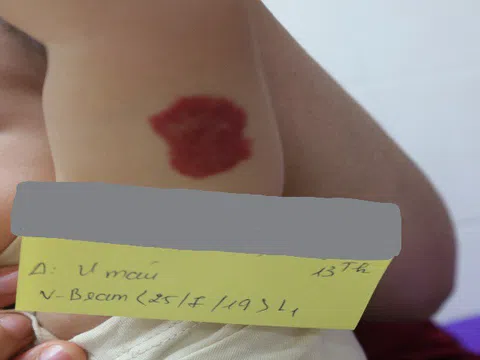 Bệnh u máu có nguy hiểm không?