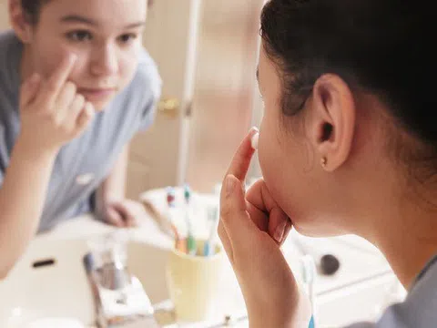 Làm thế nào để loại bỏ mụn trứng cá tuổi dậy thì?