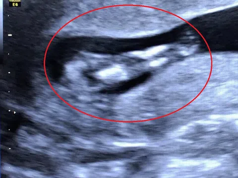 TP. Cần Thơ: Hy hữu chẩn đoán hình ảnh phát hiện thai nhi mắc hội chứng người cá