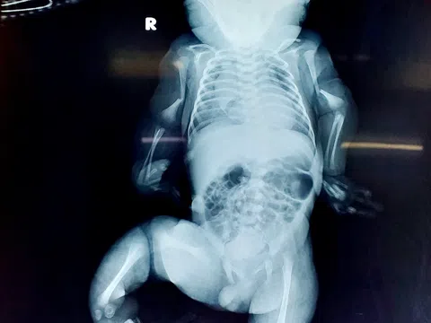 TP. Cần Thơ: Hi hữu mẹ đi sinh phát hiện con bị bệnh xương thủy tinh