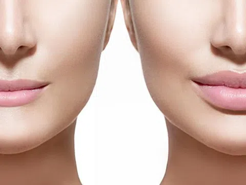 Tiêm filler có tốt không? Có hiệu quả không?