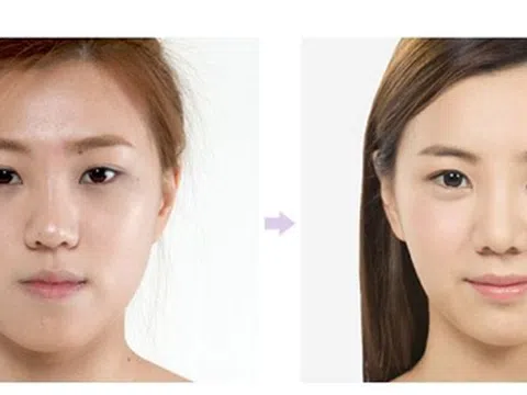 Tiêm filler dưới mắt tạo bọng mắt quyến rũ – Tại sao không?