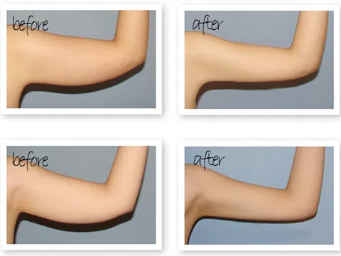 Tiêm filler giảm mỡ bắp tay – Liệu có hiệu quả không?