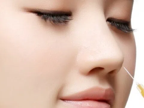 Tiêm filler nhân trung và lời cảnh tỉnh cho các chị em