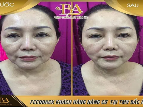 Già nhưng cũng phải trẻ đẹp: Chia sẻ của cô Hà khi nâng cơ trẻ hóa tại thẩm mỹ viện Bắc Âu