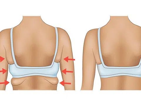 Công nghệ giảm mỡ vai và bắp tay số 1 Hoa Kỳ tại Thẩm mỹ viện Bắc Mỹ Thanh Hóa