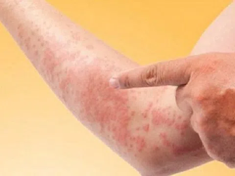 Các phương pháp trị dị ứng cồn tại nhà