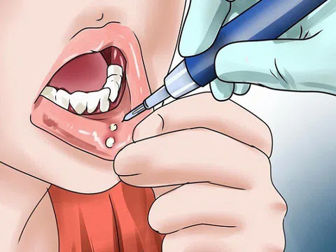 Những tác nhân gây nhiệt miệng