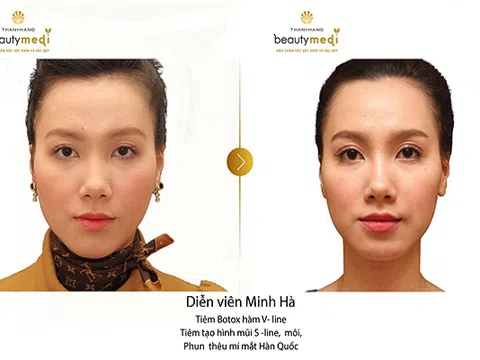 Kỳ tích thẩm mỹ, nâng mũi không phẫu thuật, đẹp tự nhiên chỉ sau 5 phút