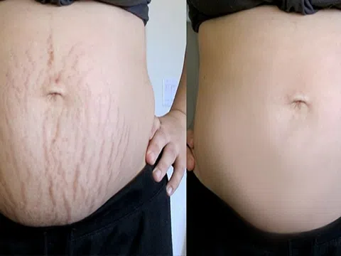 Điều trị rạn da an toàn không đau, không xâm lấn da tại Thẩm mỹ viện quốc tế Bắc Âu