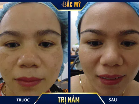 Multi Picosure Extra 2020 - Công nghệ trị nám tận gốc tiên tiến nhất năm 2020 tại Thẩm mỹ viện Bắc Mỹ