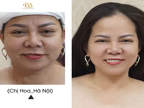 Off 50% công nghệ Ultherapy: Nâng cơ mặt - Da săn chắc - Không cần phẫu thuật