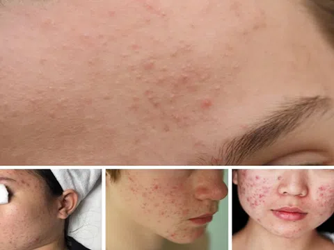 Nguyên nhân hình thành và phương pháp điều trị mụn trứng cá