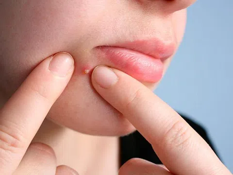 Làm thế nào để giảm sưng sau khi nặn mụn?