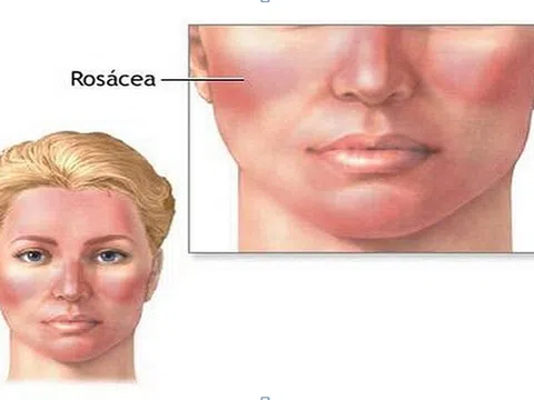 Da mặt thường xuyên bị đỏ phải làm sao?