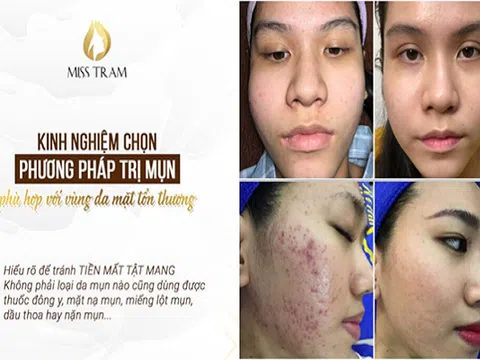 Cách nặn mụn bọc, mụn mủ an toàn tại nhà